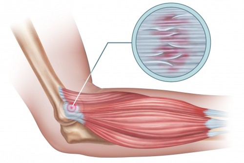 Insertion tibialis poterior